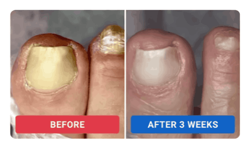 Orivelle Anti-Fungal Pen customer-  ~Rachel M. –Oregon, USA