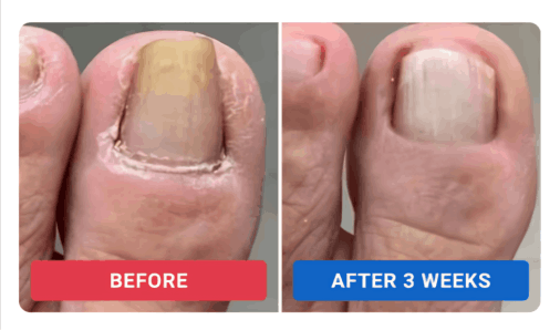 Orivelle Anti-Fungal Pen Customer ~Dan R. –Colorado, USA